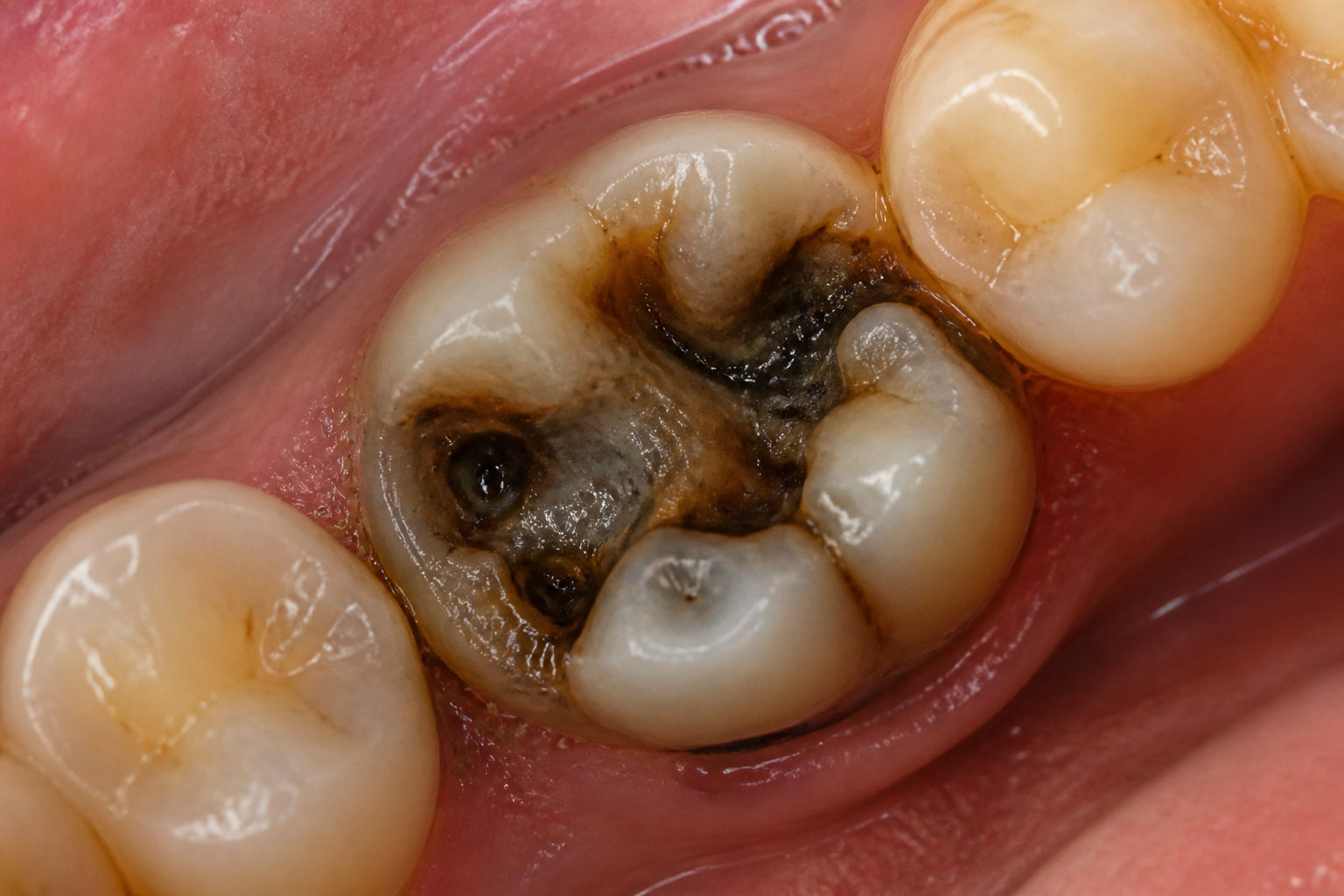 Comment reconnaître les signes d'une dent infectée ?