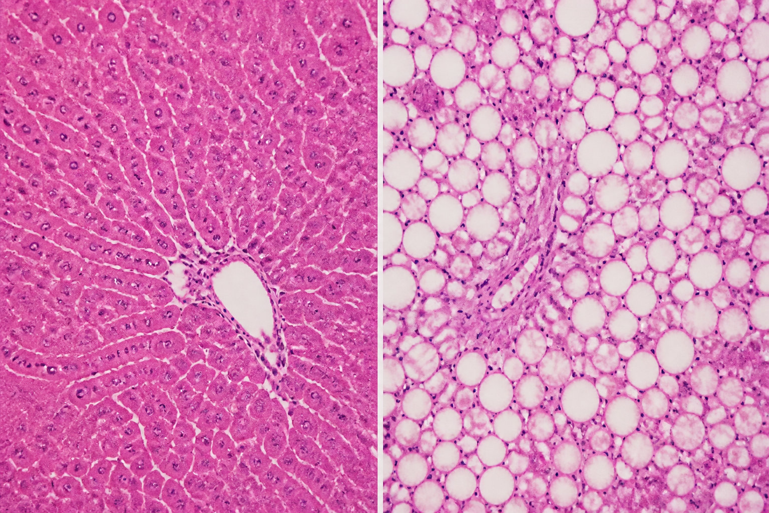 3 Stages of Liver Disease and Metabolic Decline