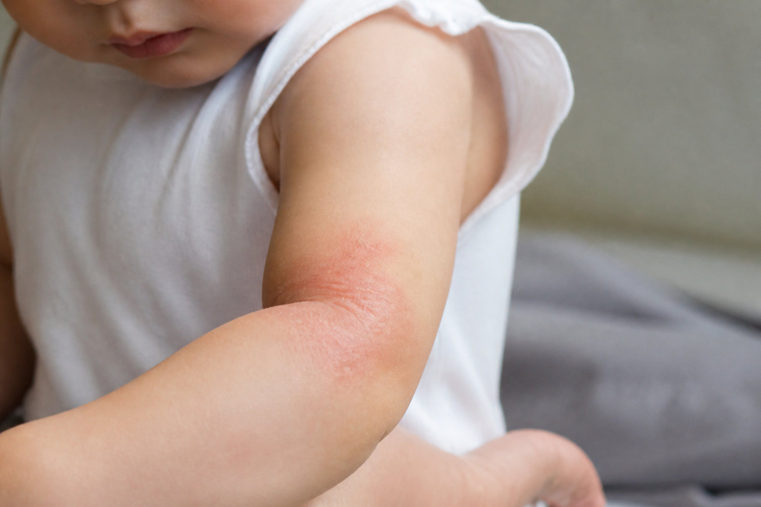 Zoom sur l'eczéma et les réactions allergiques fréquentes